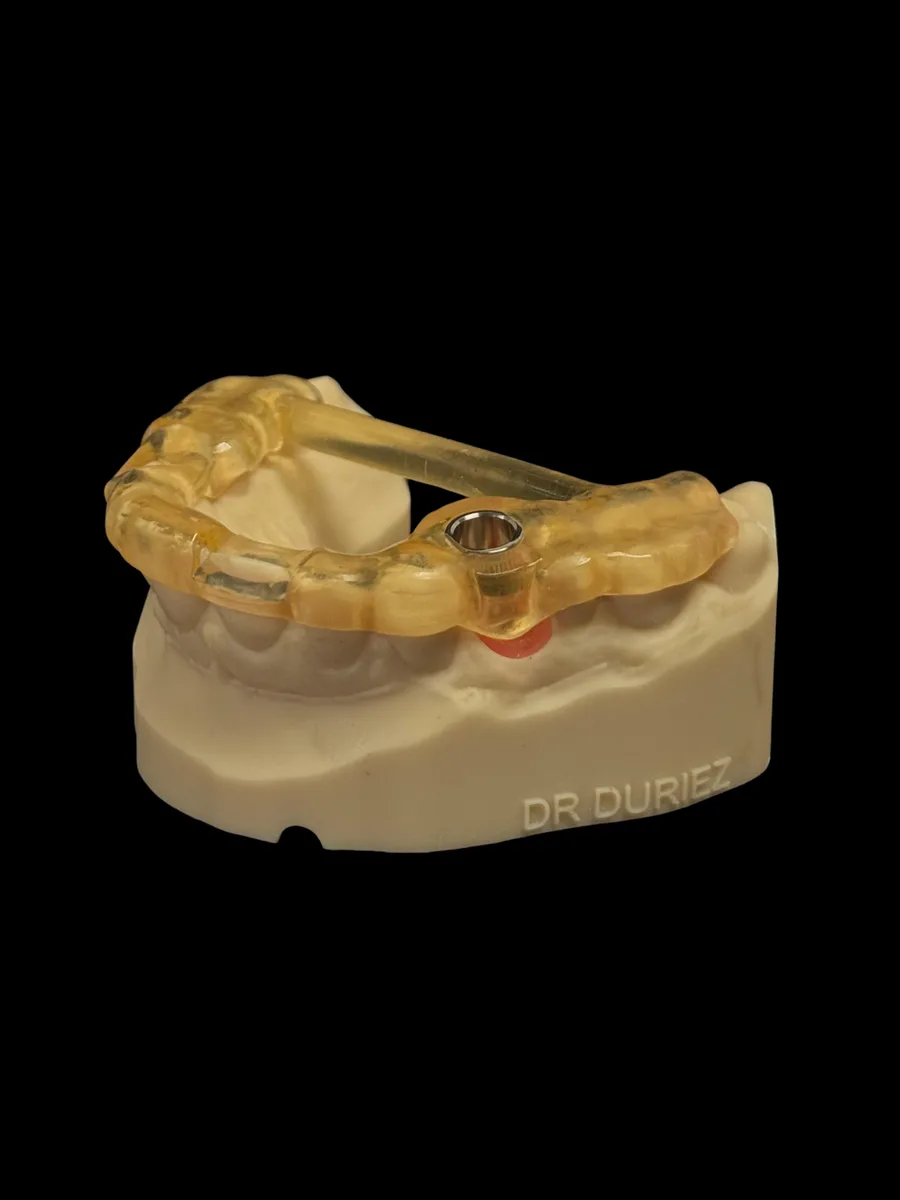 Guide chirurgical sur mesure