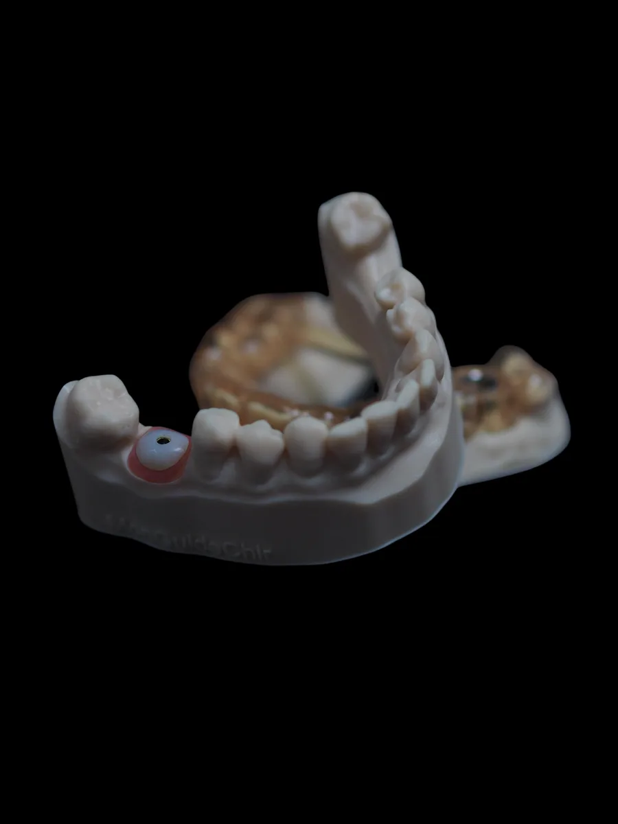 Couronne sur implant